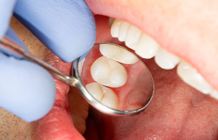 かみ合わせ治療の内容