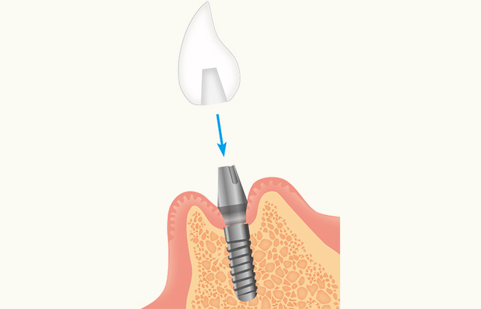インプラント治療の流れ_人工歯の型取りと仮歯の装着