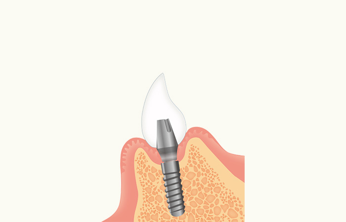 インプラント治療の流れ_人工歯の装着