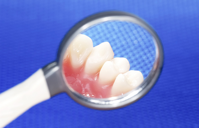 予防と定期検診で歯を残す