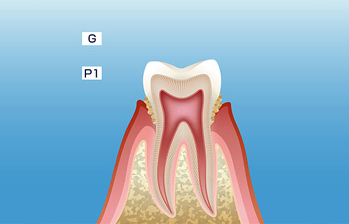歯周病の進行_歯肉炎