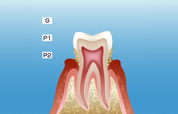 歯周病の進行_軽度の歯周炎