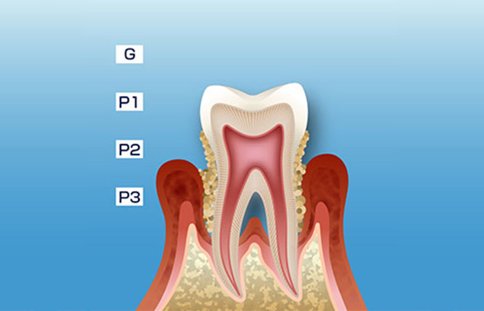 歯周病の進行_中度の歯周炎