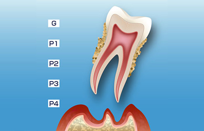 歯周病の進行_中度の歯周炎