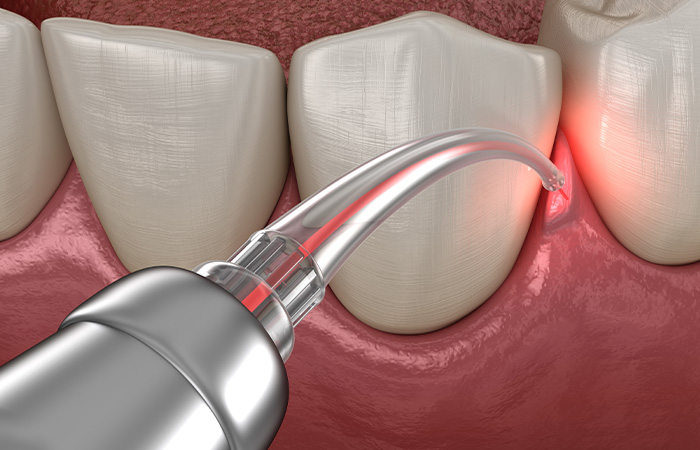 治療の流れ_進行した歯周病の治療