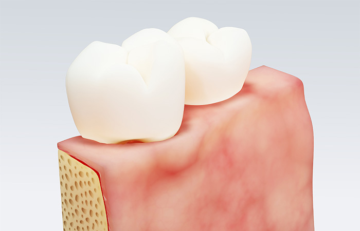 歯周病は旧石器時代から