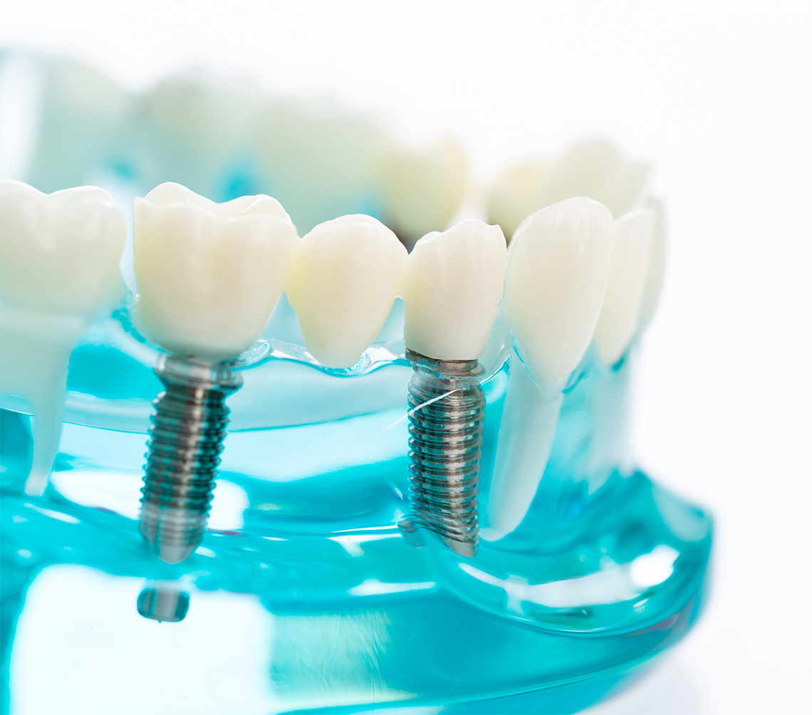 診療案内_インプラント